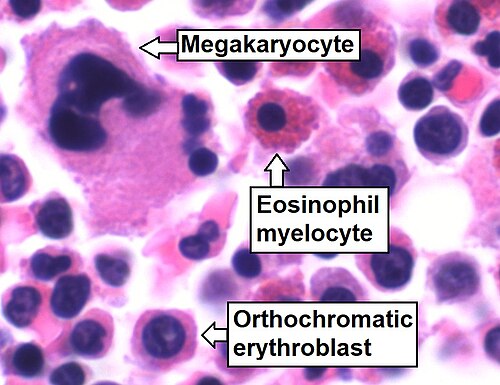Bone marrow aspirate, showing normal trilineage hematopoiesis: myelomonocytic cells (an eosinophil myelocyte marked), erythroid cells (an orthochromatic erythroblast marked), and megakaryocytic cells.