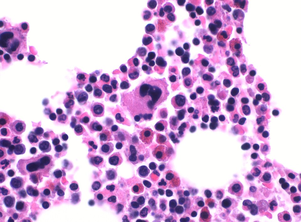 Trilineage hematopoiesis in bone marrow: erythroid, myeloid, and megakaryocytic precursors including myelocyte-stage cells.